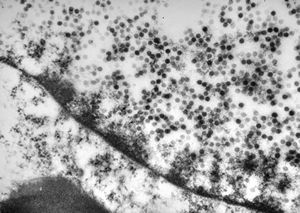 papilomavirus - verruca vulgaris papilomavirus - verruca vulgaris
